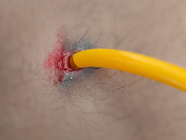 Slight bleeding at the incision point, especially after a tug or a bath, is normal.