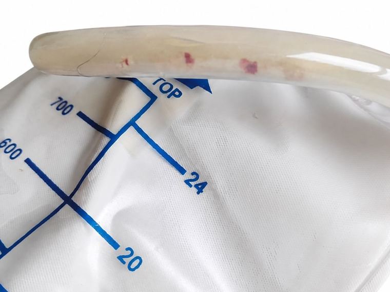 Small dark red specks of blood settled at the top of the urine collection bag