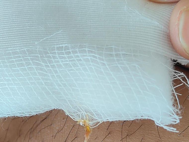 The same discharge picked up on the dressing when it is changed