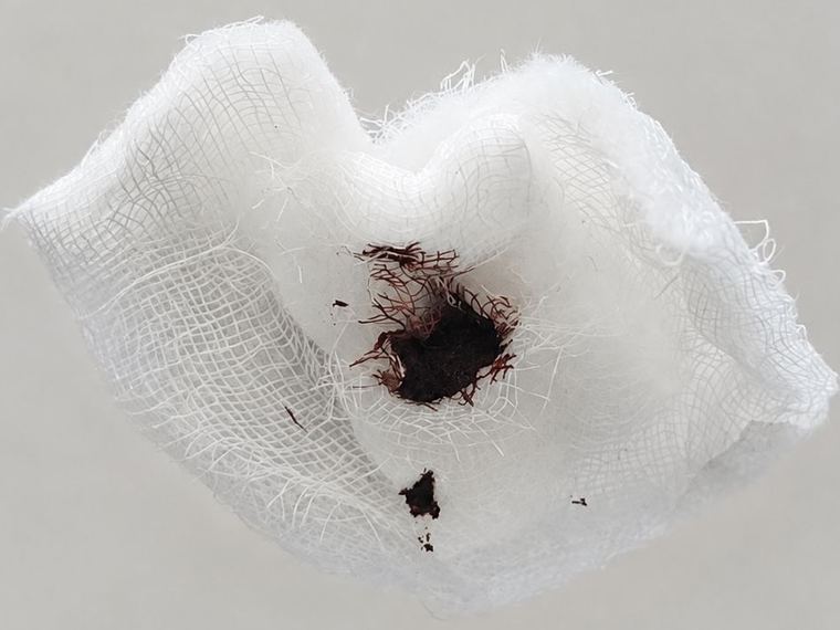 Such a small, dark or rusty spot of old blood can be seen even after a few weeks.