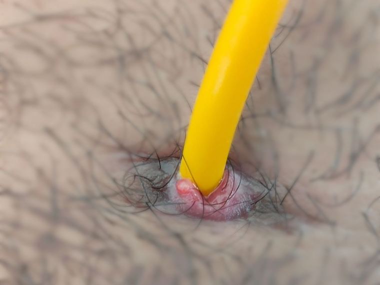 Granulation tissue forming a raised red rim around the suprapubic catheter