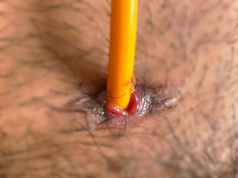 Close-up of glossy red granulation tissue hugging the catheter where it enters the skin