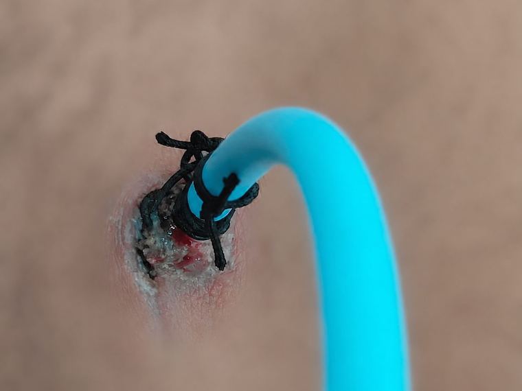 Creamy discharge collecting where the suprapubic catheter meets the skin
