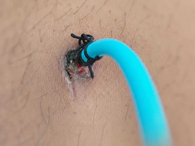 A stiff catheter holds its own curve instead of following your body, making it tug at the incision point.